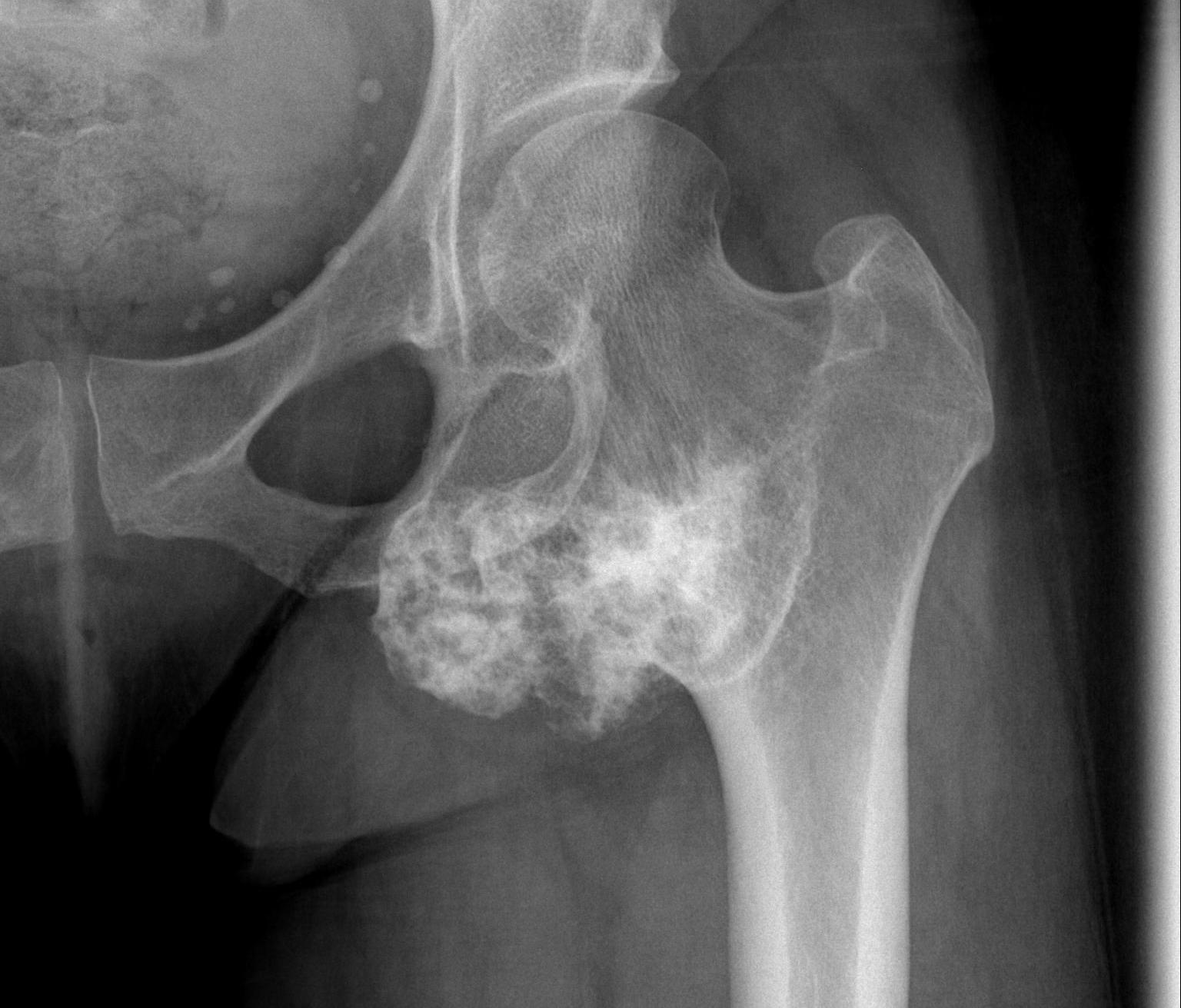 Proximal Femur Bony Tumour0001